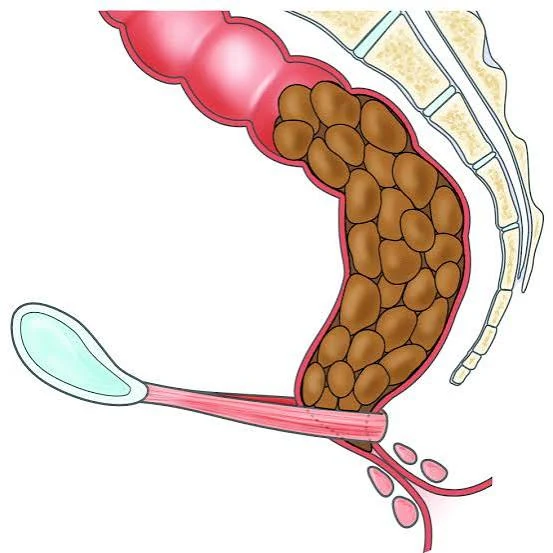 Educational illustration of stool retained in the rectum