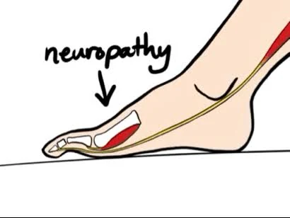 Simple educational drawing of a foot and a highlighted nerve pathway